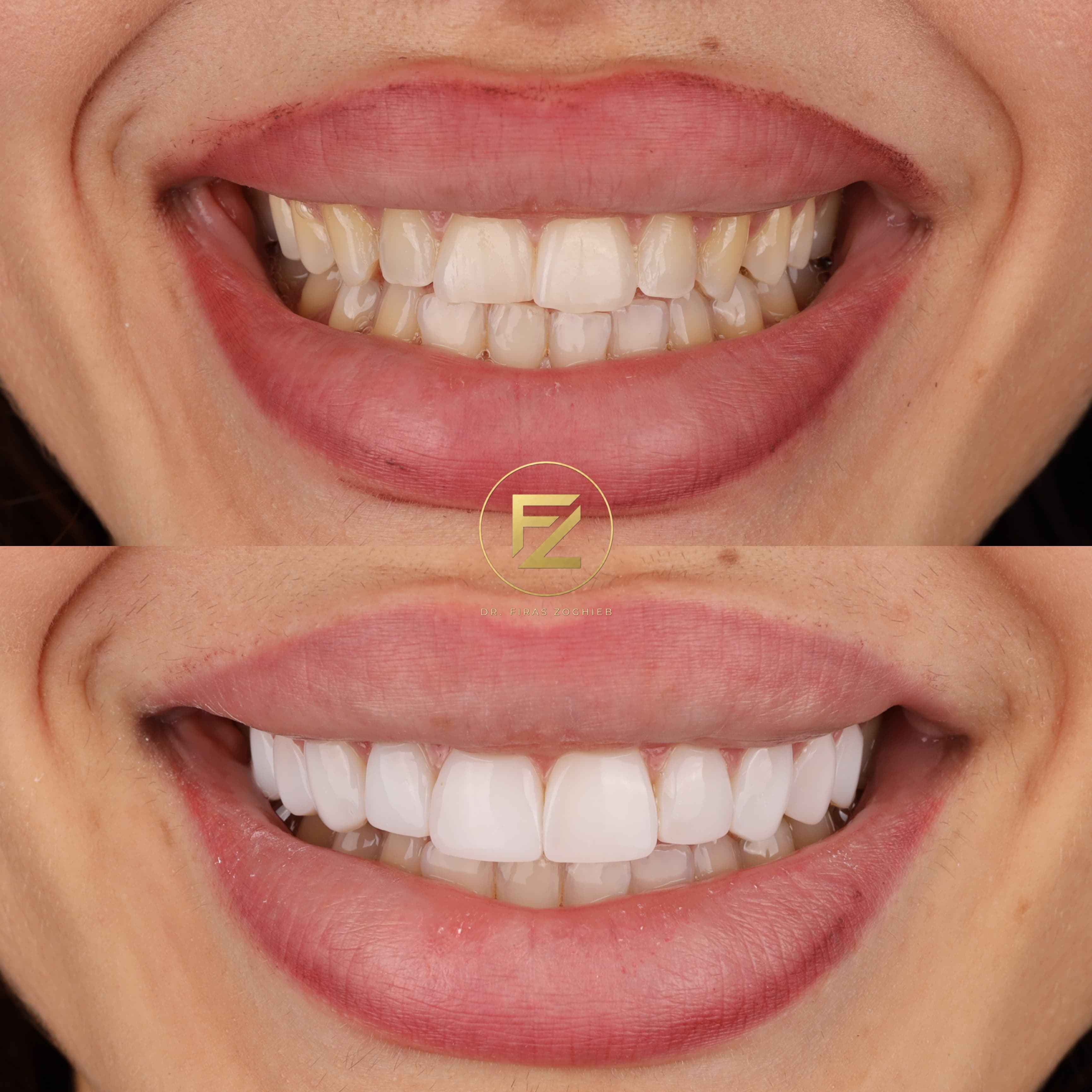 Stained Teeth