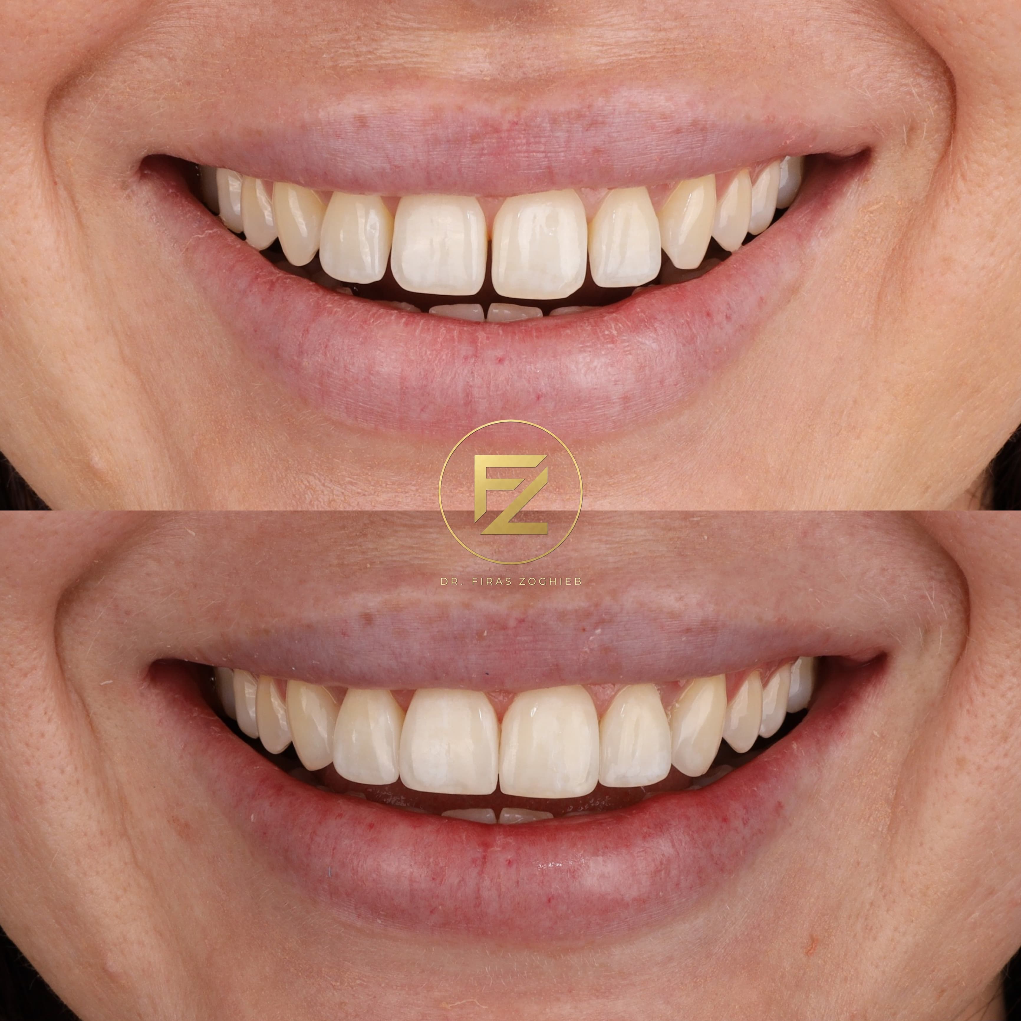 Gapped Teeth
