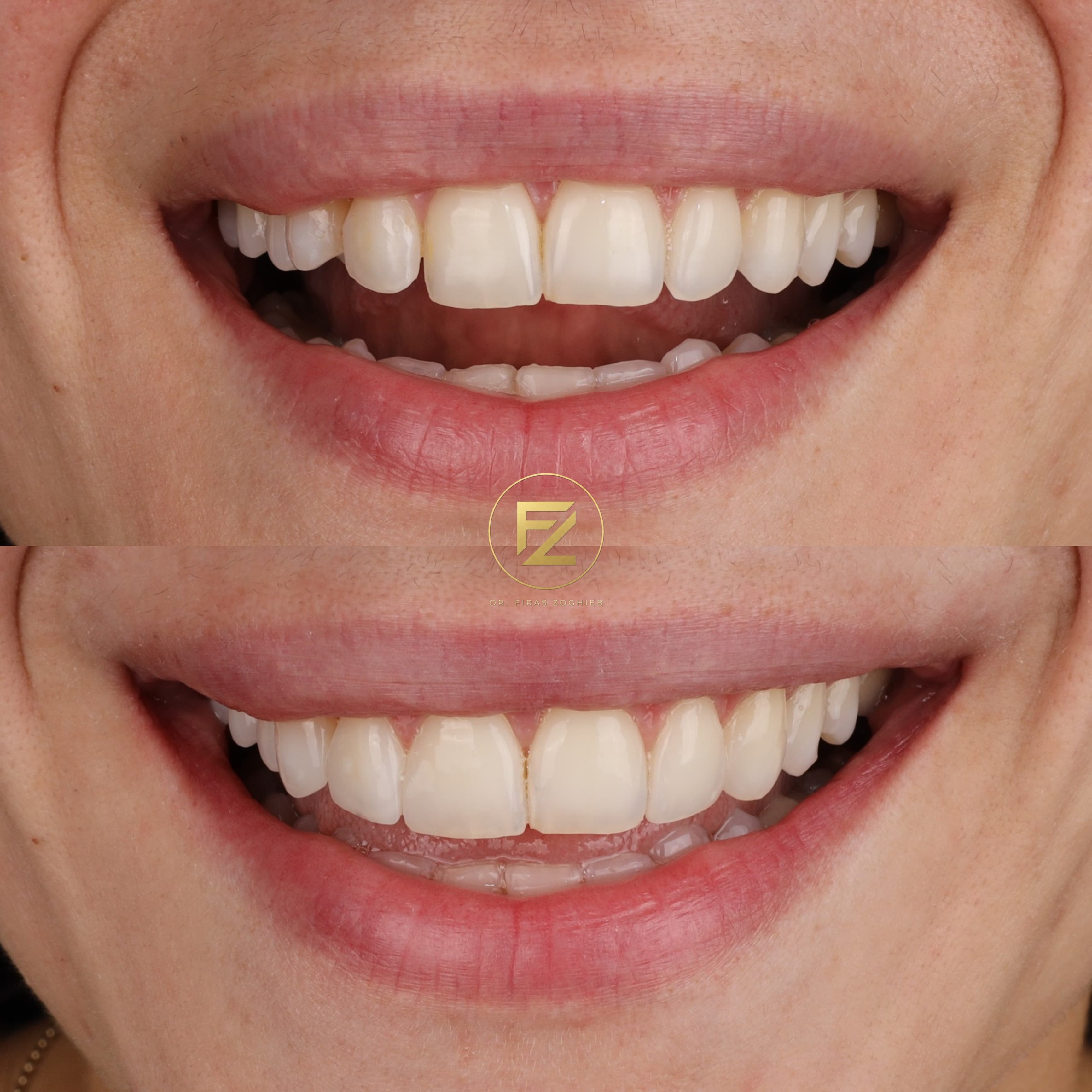 Composite Edge Bonding