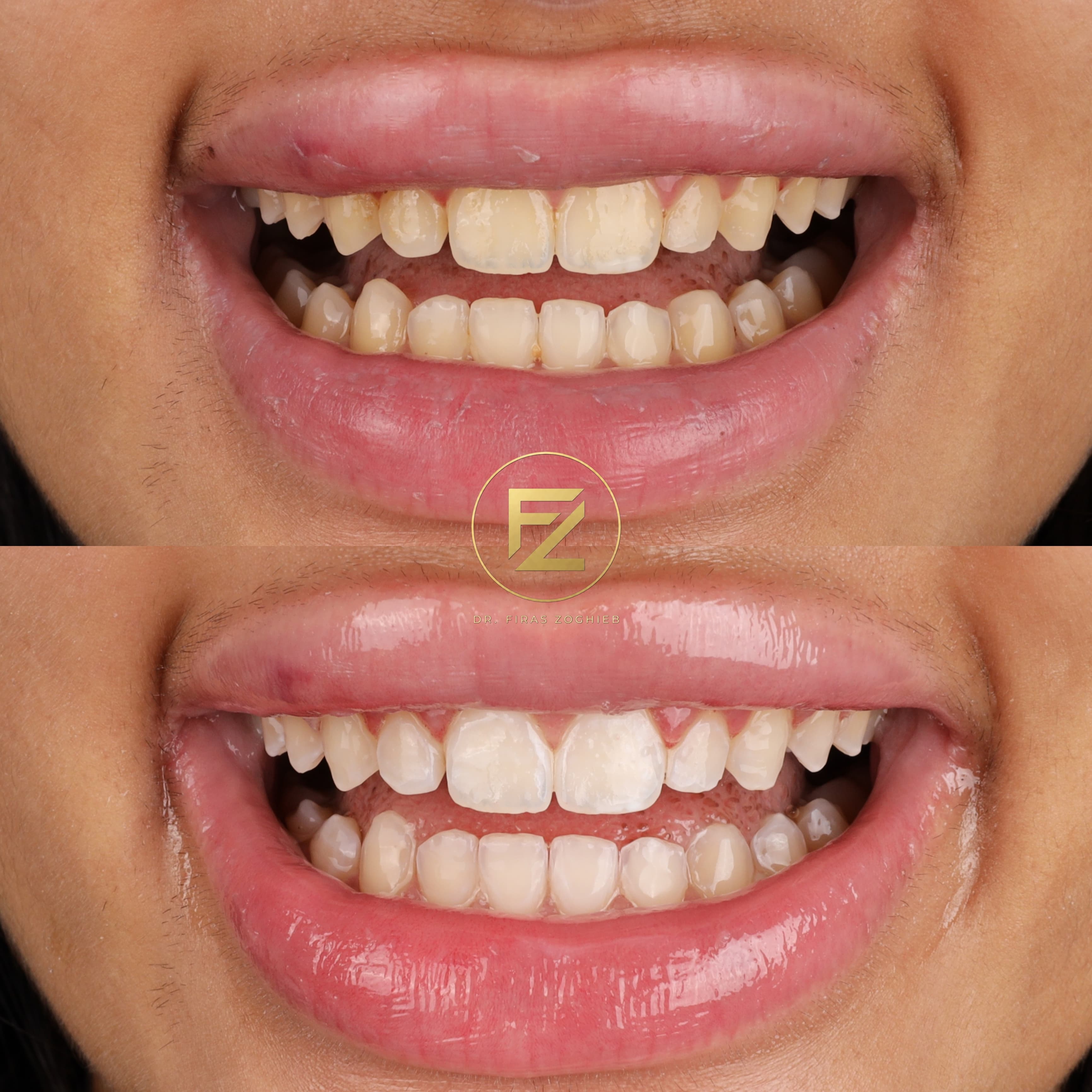 Teeth Whitening