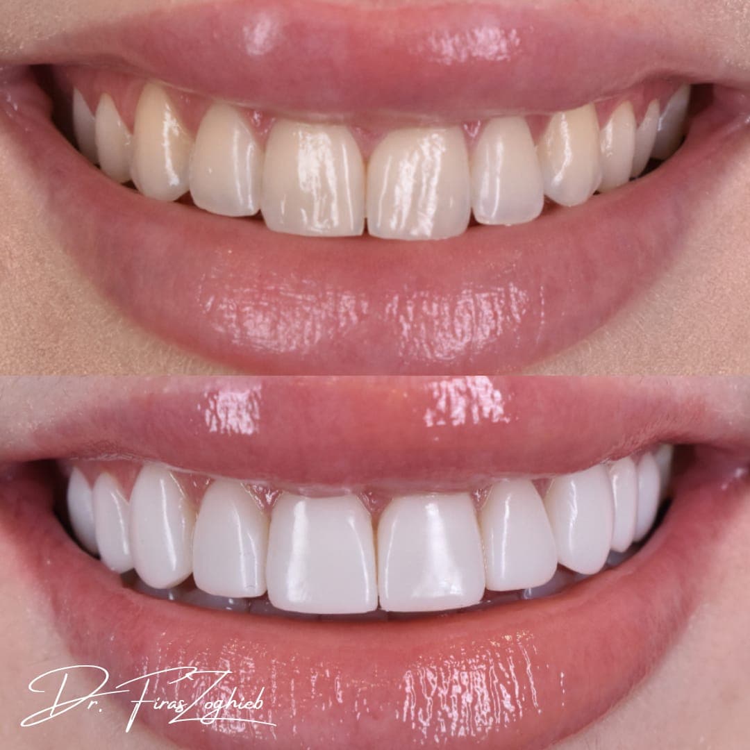 Before & After - Composite Bonding