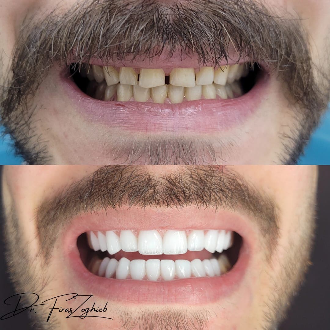 Porcelain Veneers