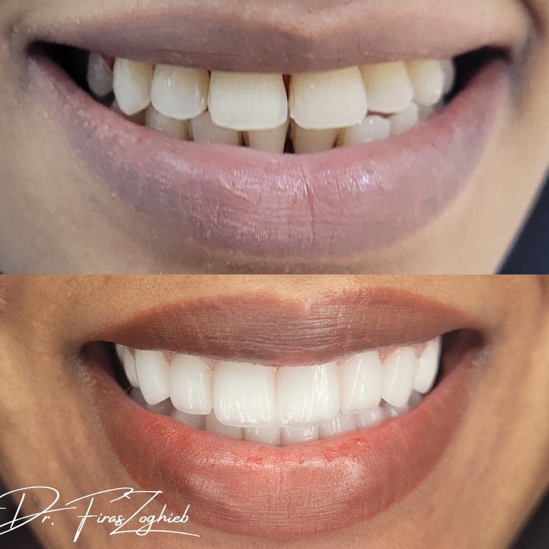 Porcelain Veneers — before & after 1