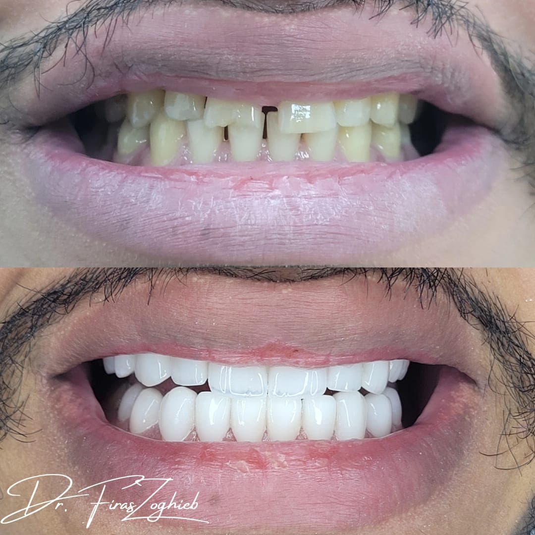 Porcelain Veneers — before & after 2