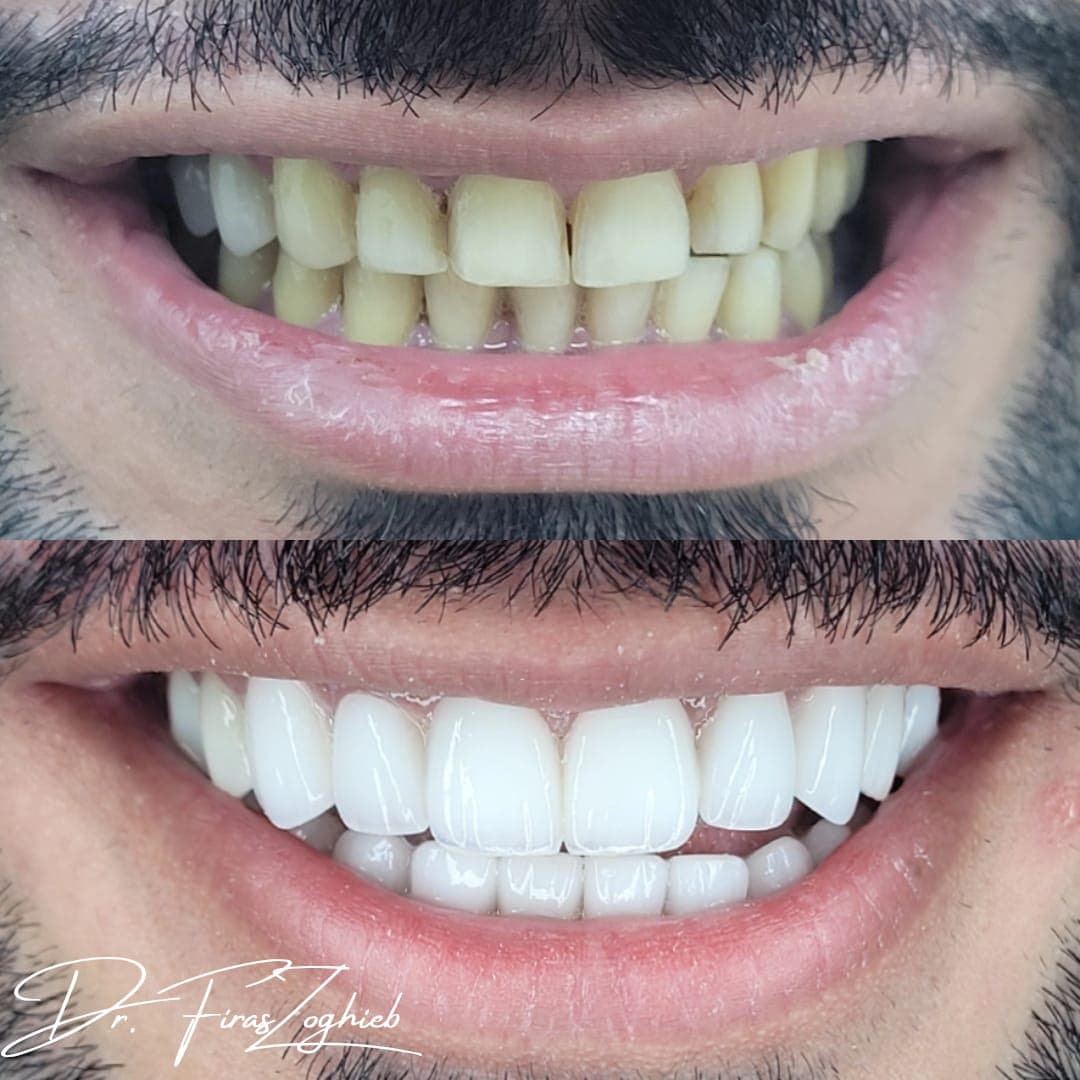 Porcelain Veneers — before & after 3