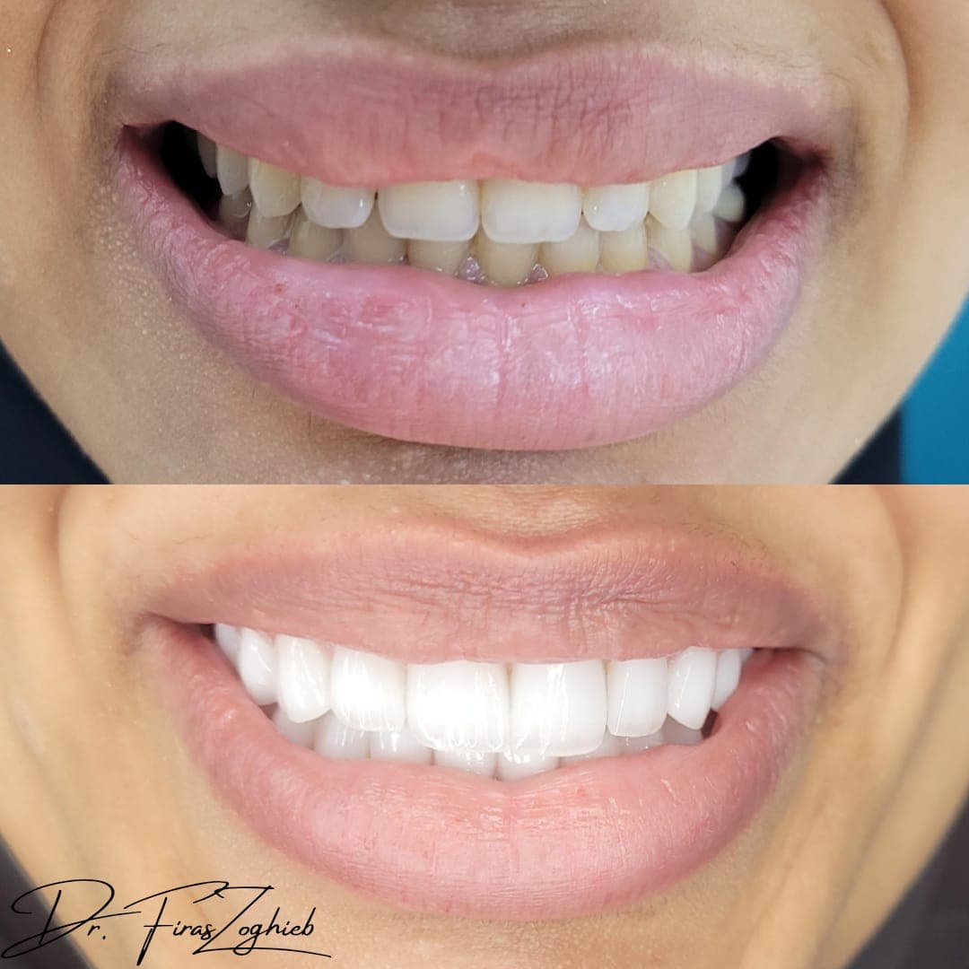 Porcelain Veneers — before & after 5