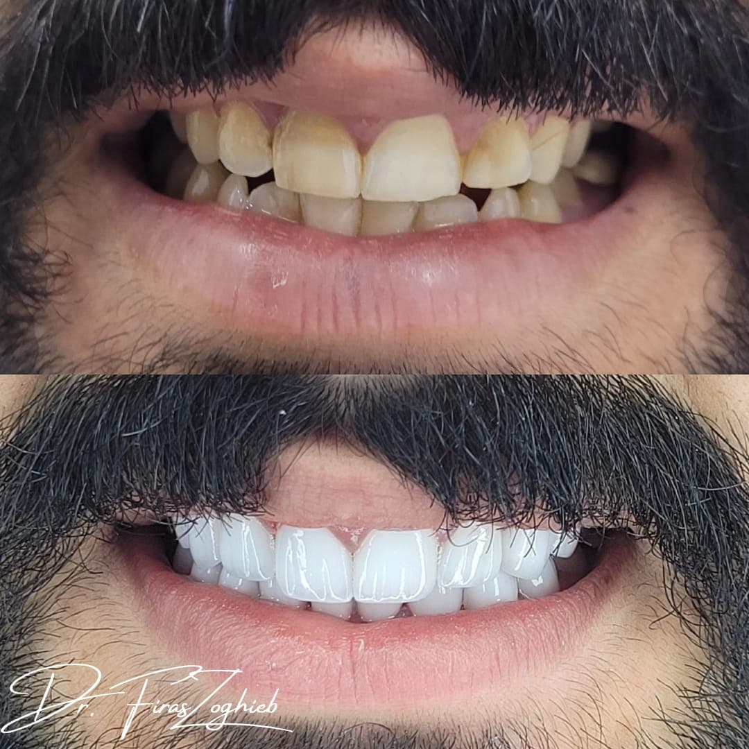 Porcelain Veneers — before & after 6