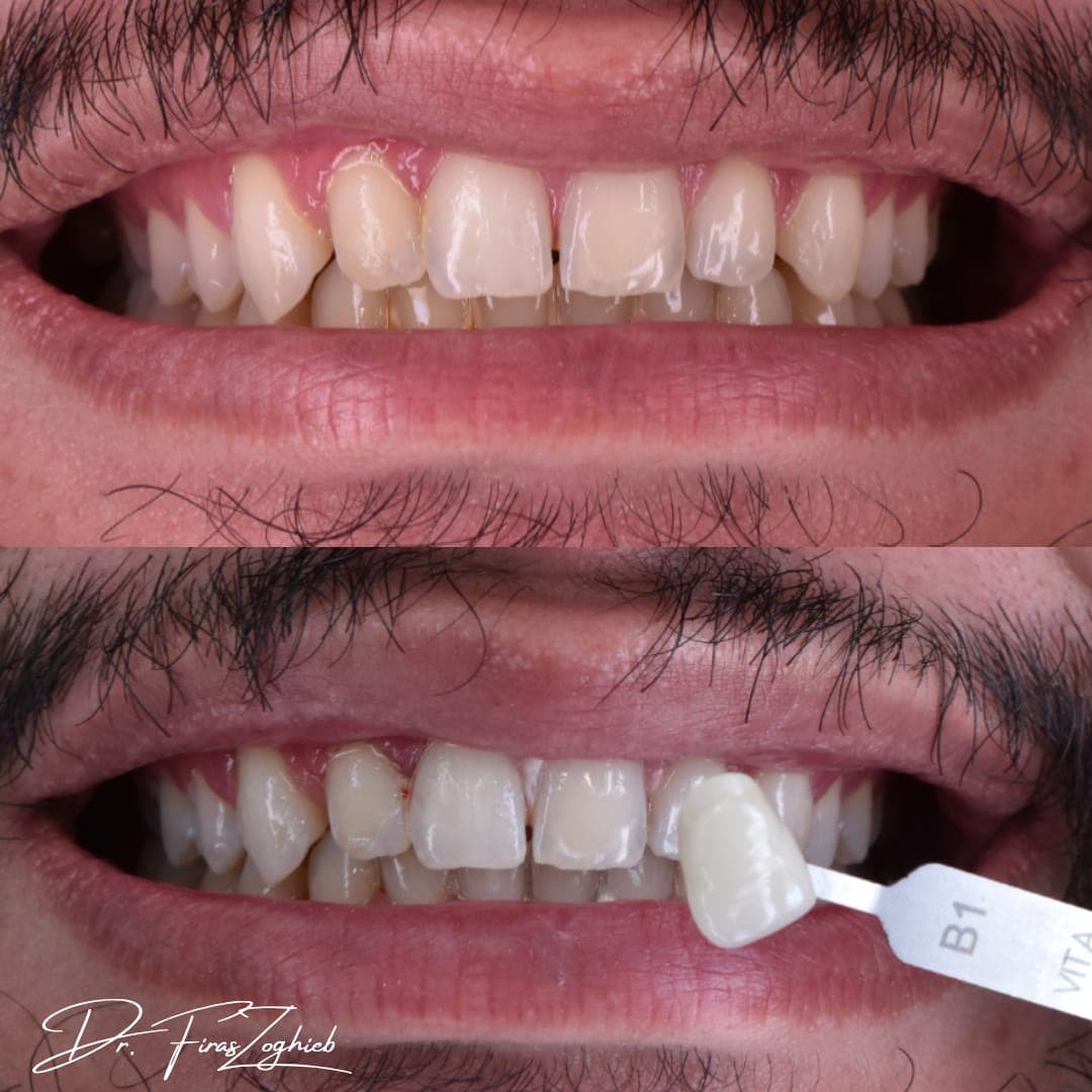 Teeth Whitening — before & after 1