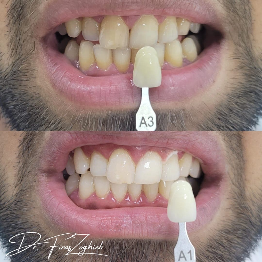 Teeth Whitening — before & after 2