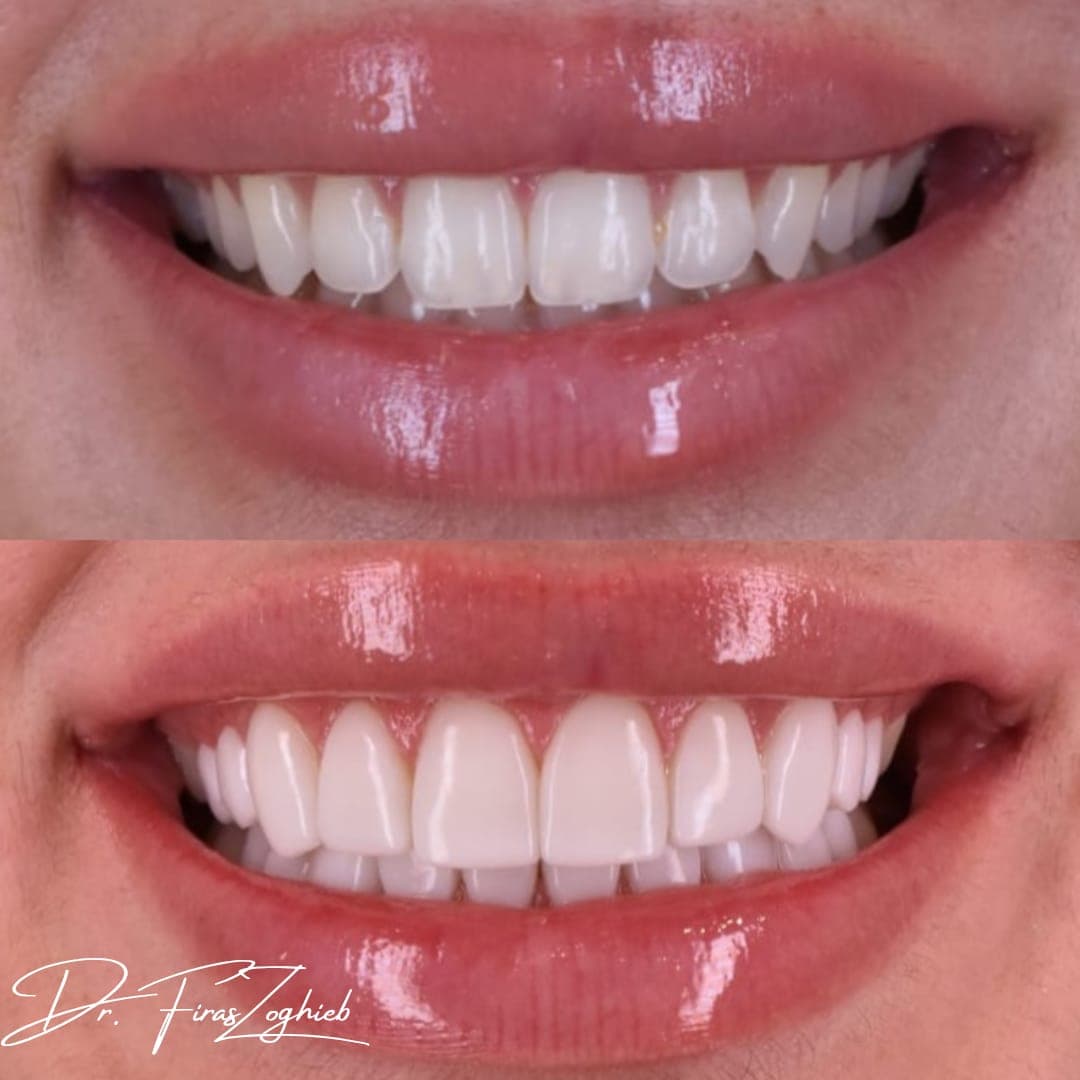 Composite Bonding — before & after 1