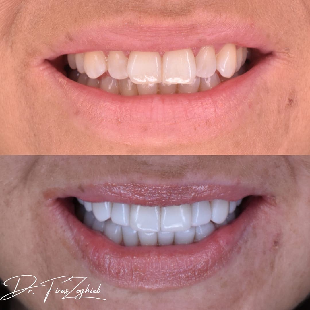 Composite Bonding — before & after 4