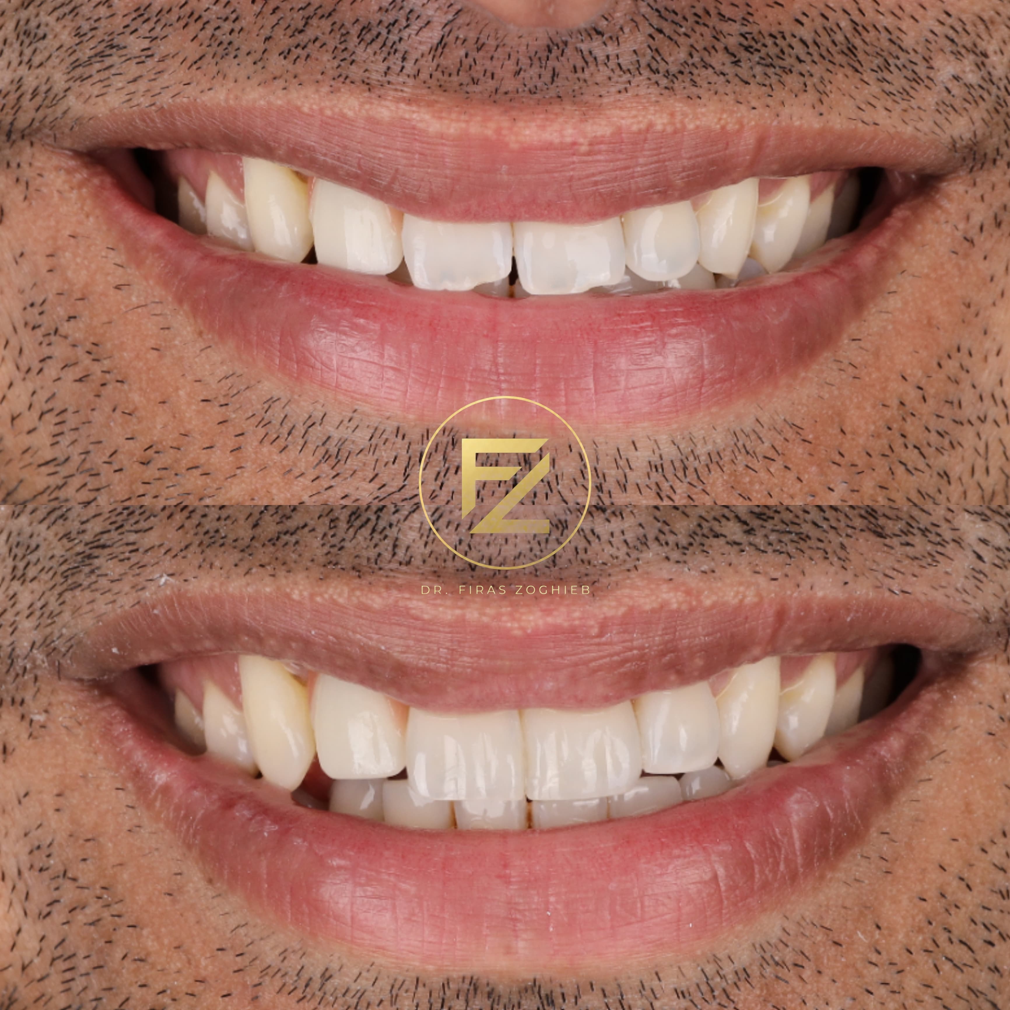 Can Composite Bonding Fix Uneven Teeth?
