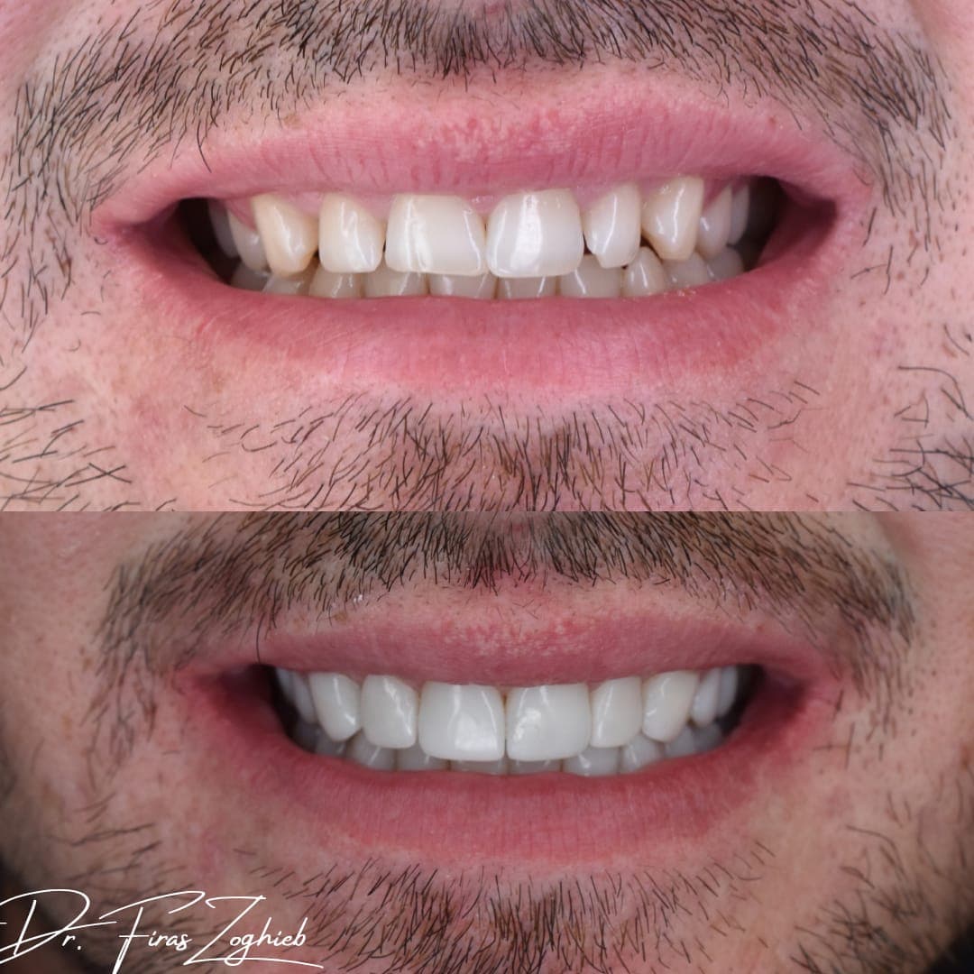Composite Bonding Before and After: What Results Can You Expect?