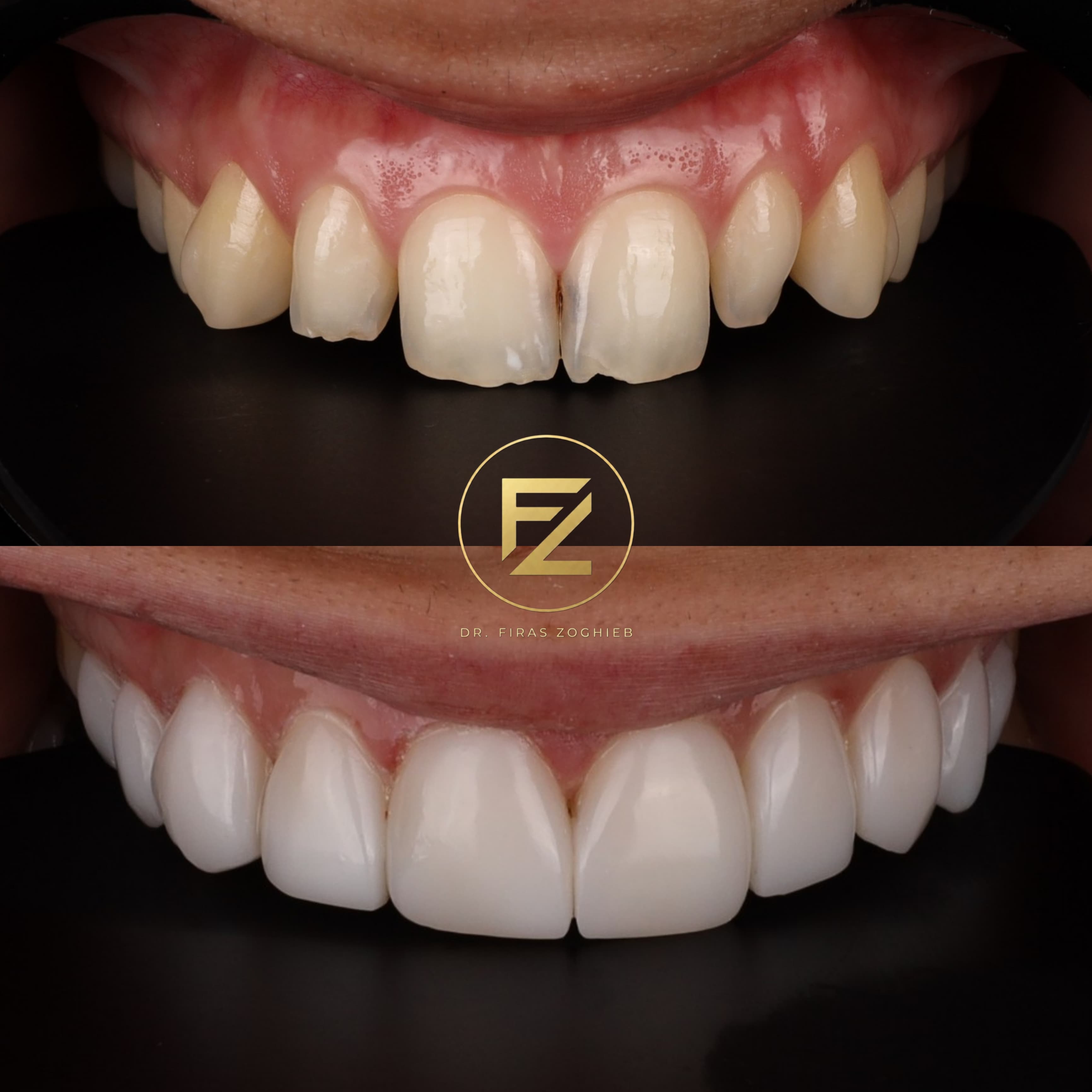 Composite Bonding — case 5