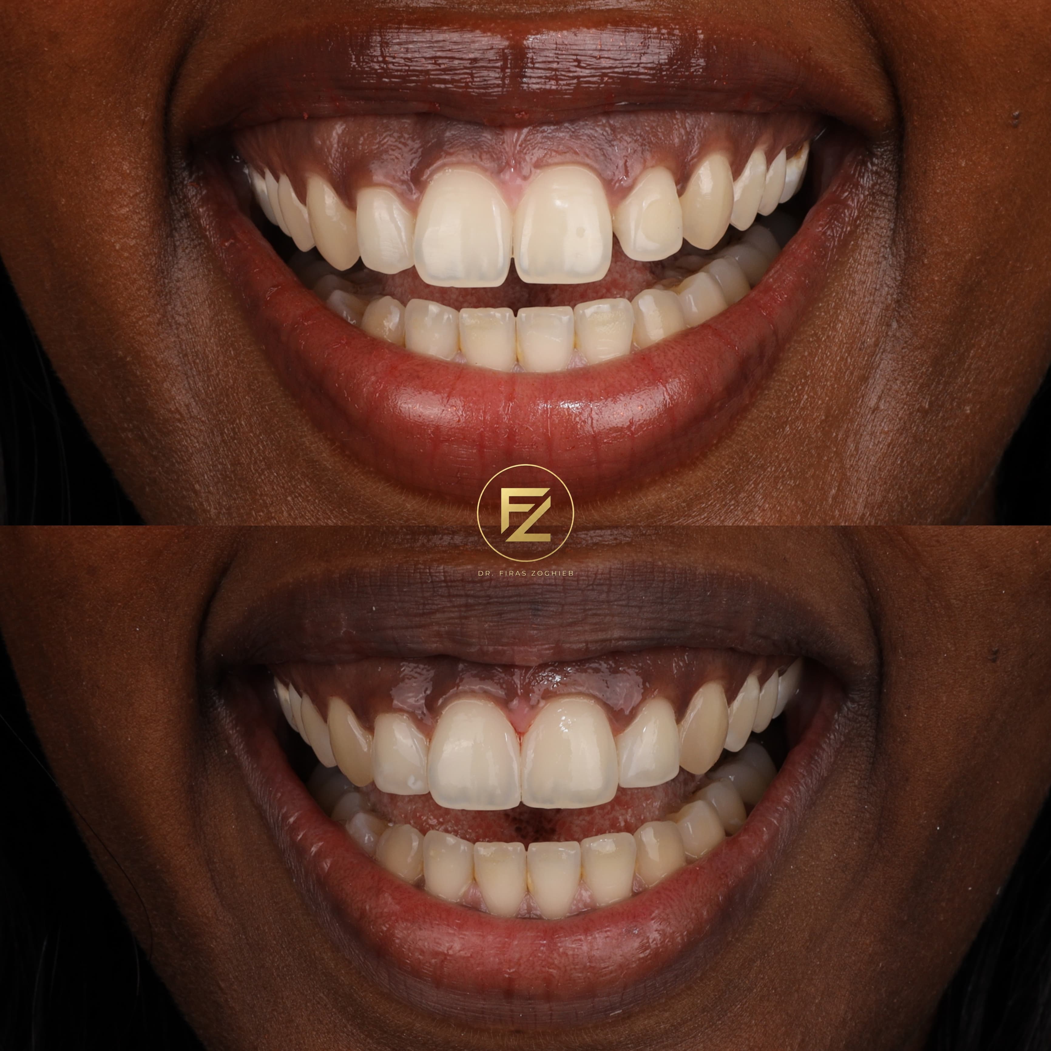 Gapped Teeth
