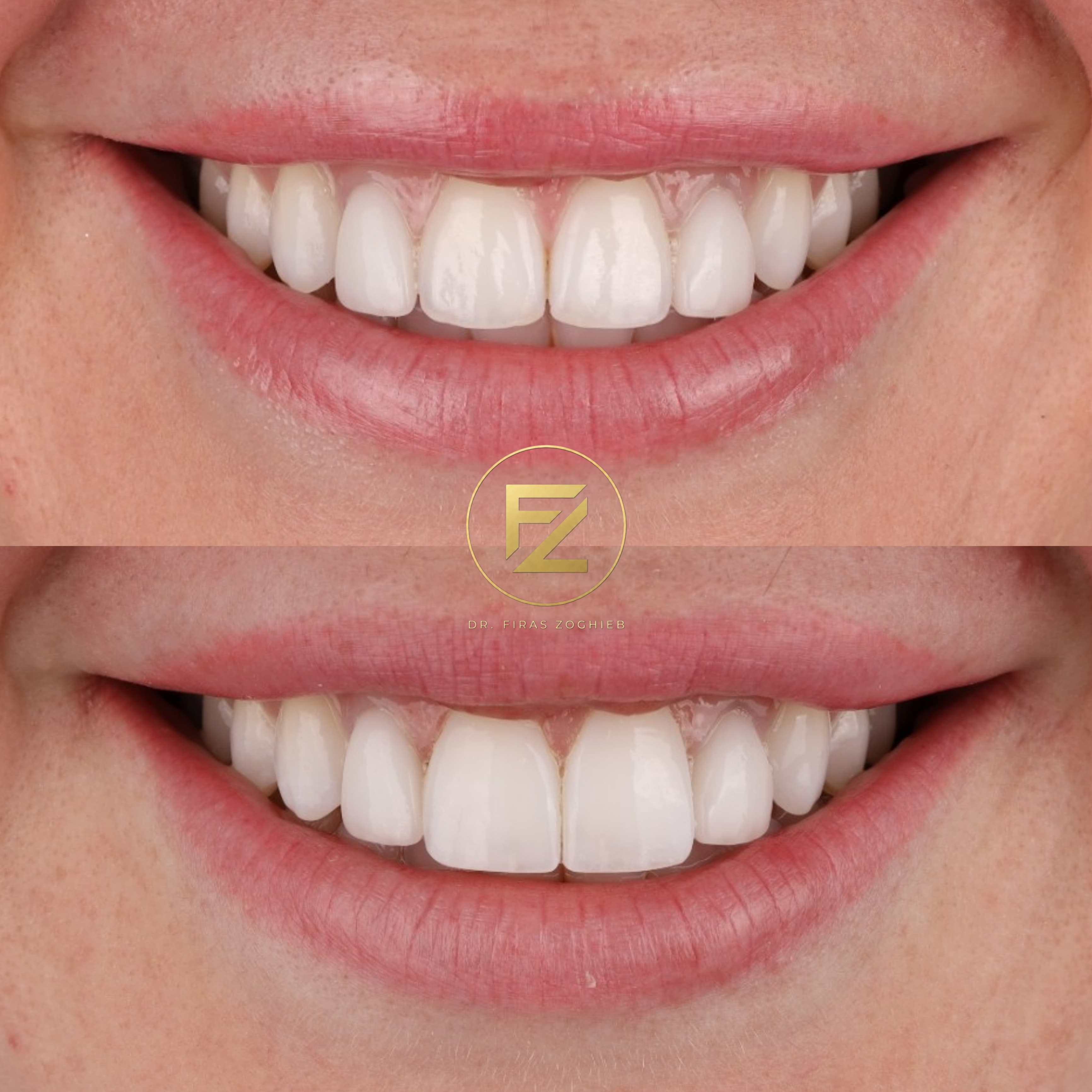Front Teeth Enhancement