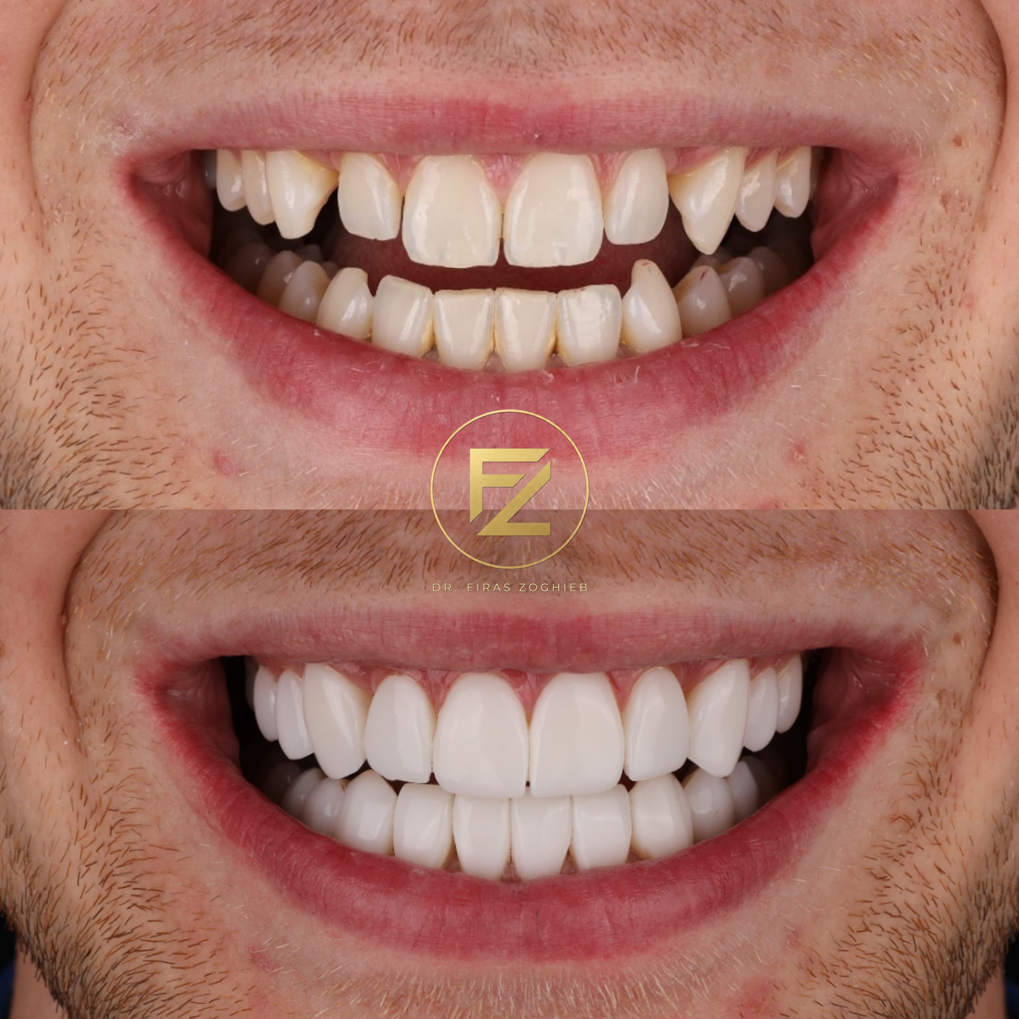 Composite Bonding — case 6