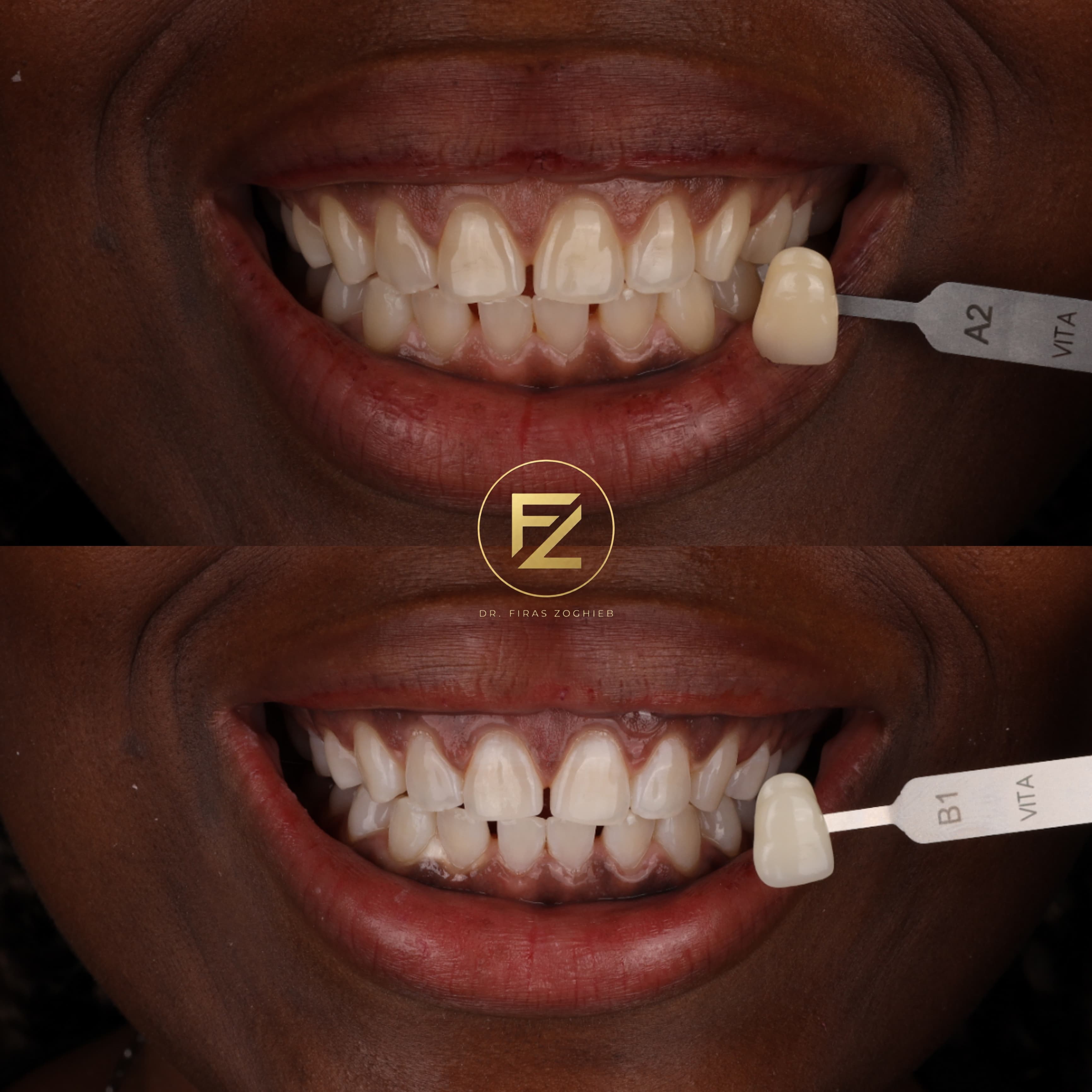 Is Professional Teeth Whitening Safe in Dubai? What Patients Should Know