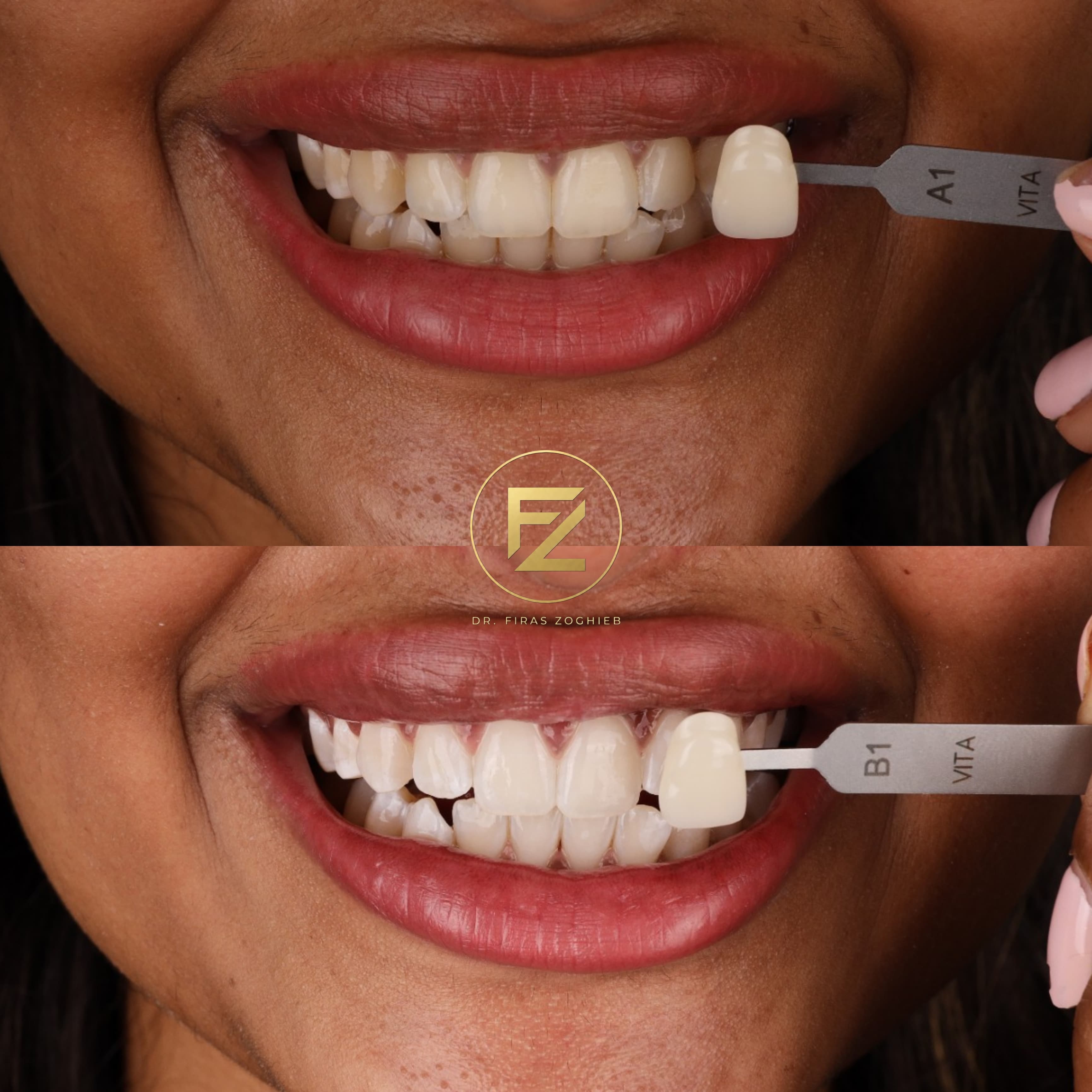 How Long Does Teeth Whitening Last in Dubai? What Patients Should Know