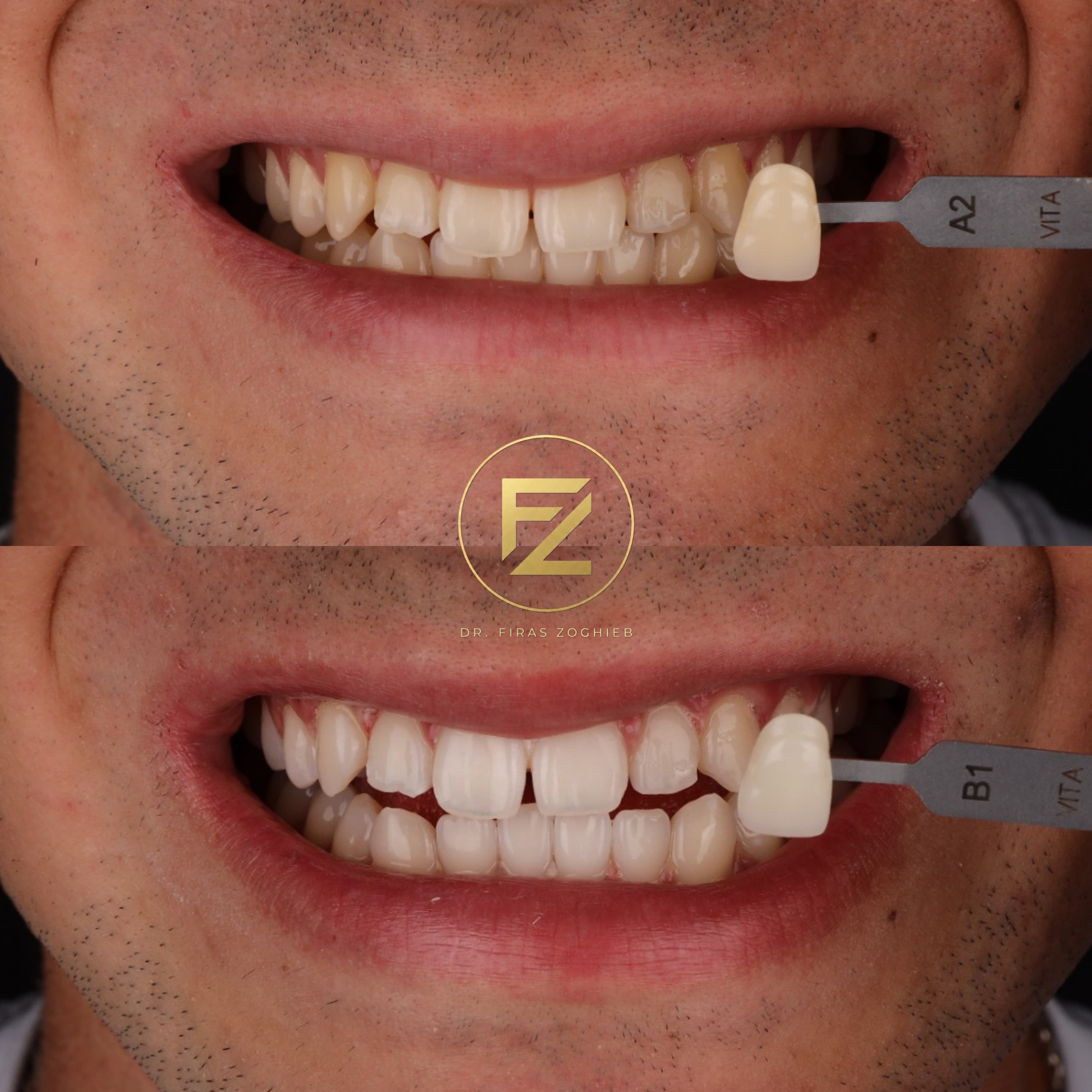 Teeth Whitening — case 1