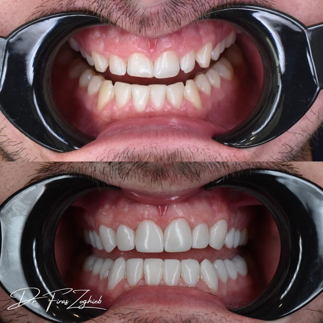 Composite Bonding vs Crowns: Which Treatment Is Right for You?