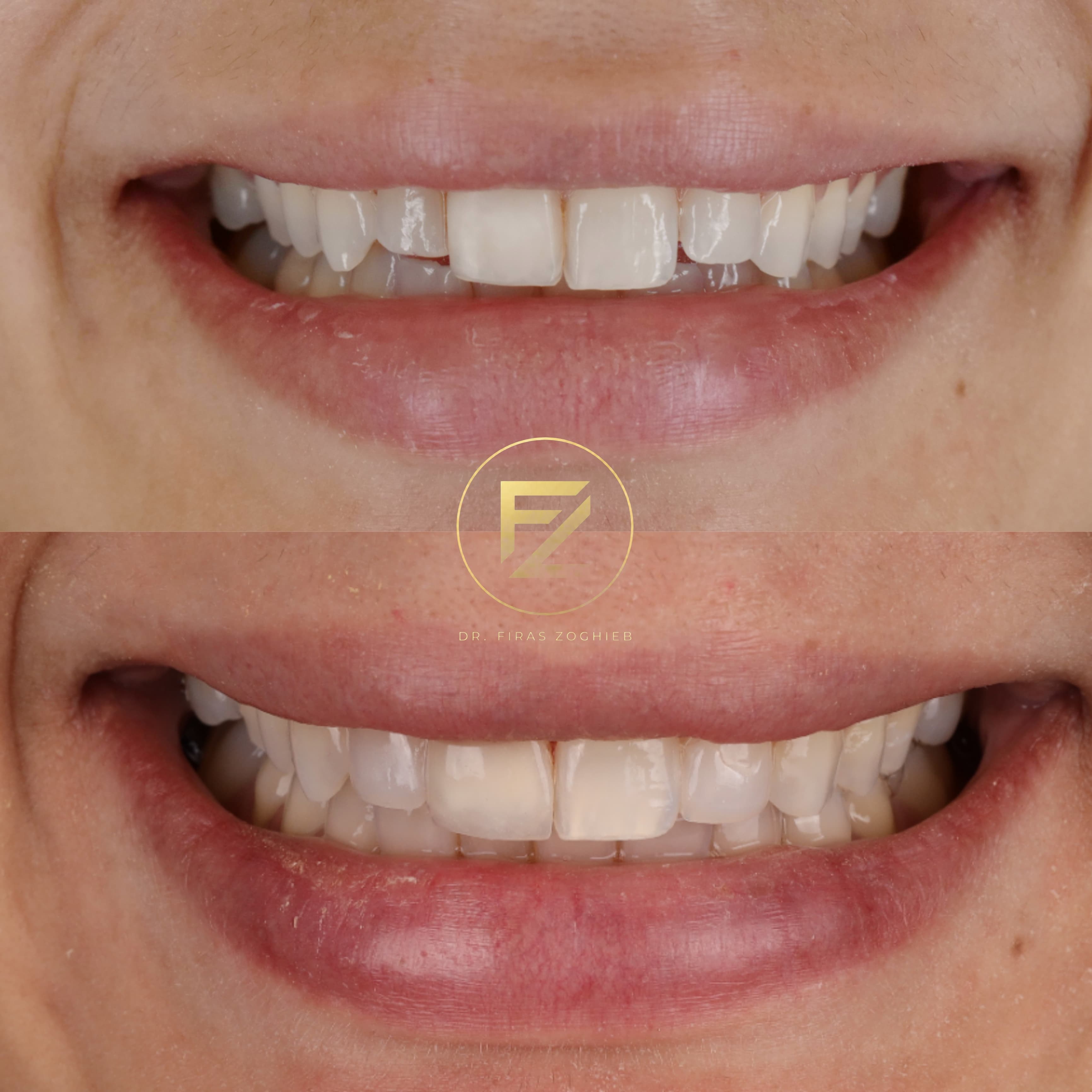 What Is Composite Bonding in Dubai? Benefits, Process, and Who It Is For