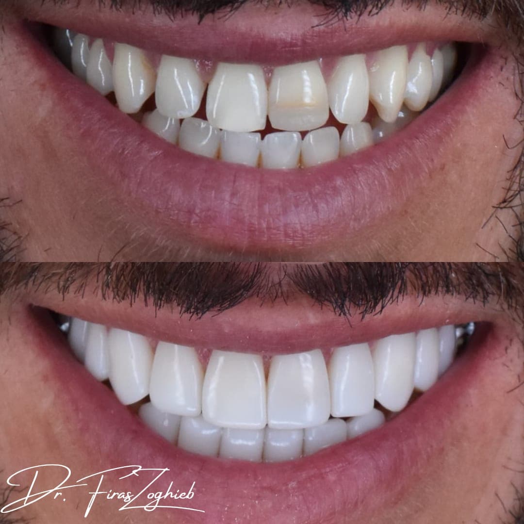 How Long Does Composite Bonding Last in Dubai? What Patients Should Know